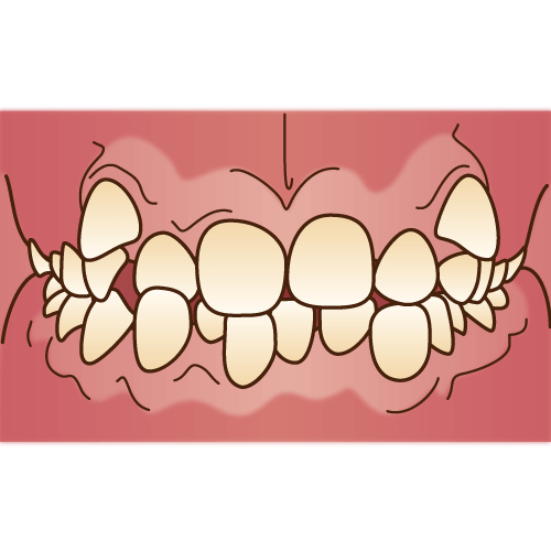 デコボコの歯並び（叢生：そうせい）