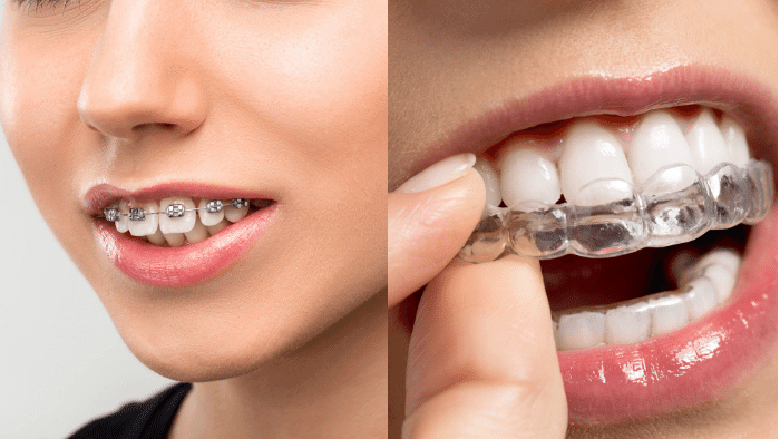 出っ歯がひどくなるケースに該当する場合の対処法